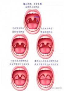 扁桃?扁桃体发炎最快治疗方法!